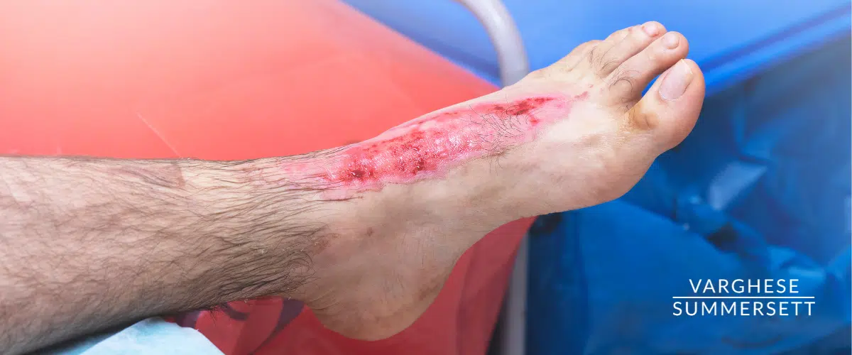 Burn from contact with hot surfaces in car accident