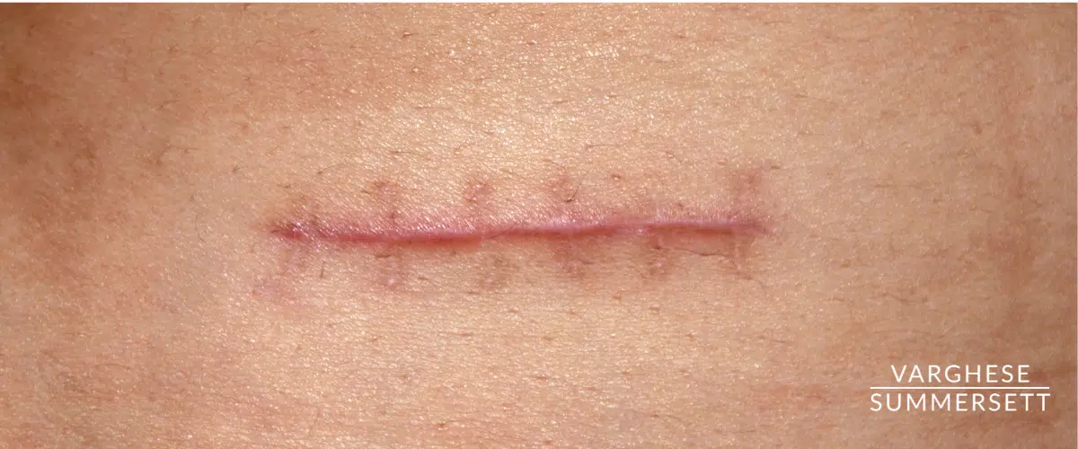 Scarring possible in a car accident