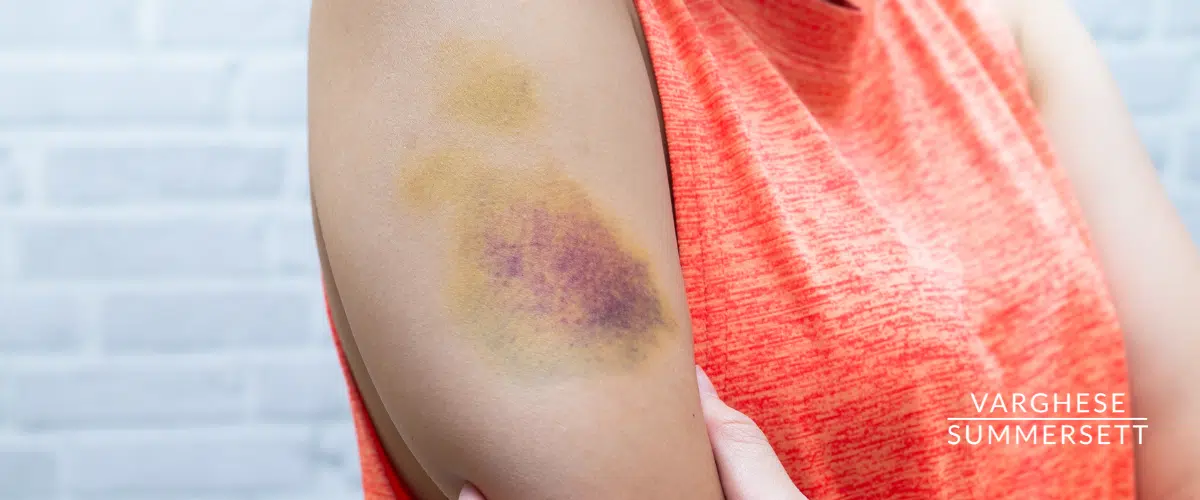 Minor bruising from car accident