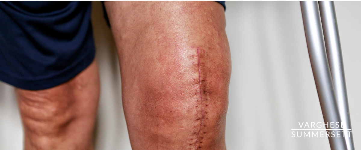 Knee injury from car accident