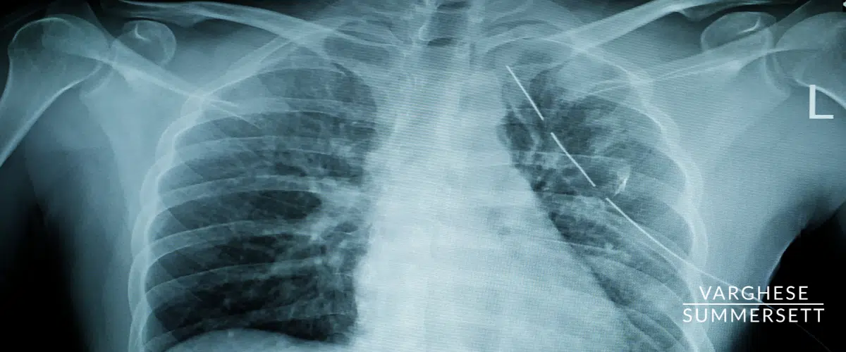 Fractured rib from car seat belt