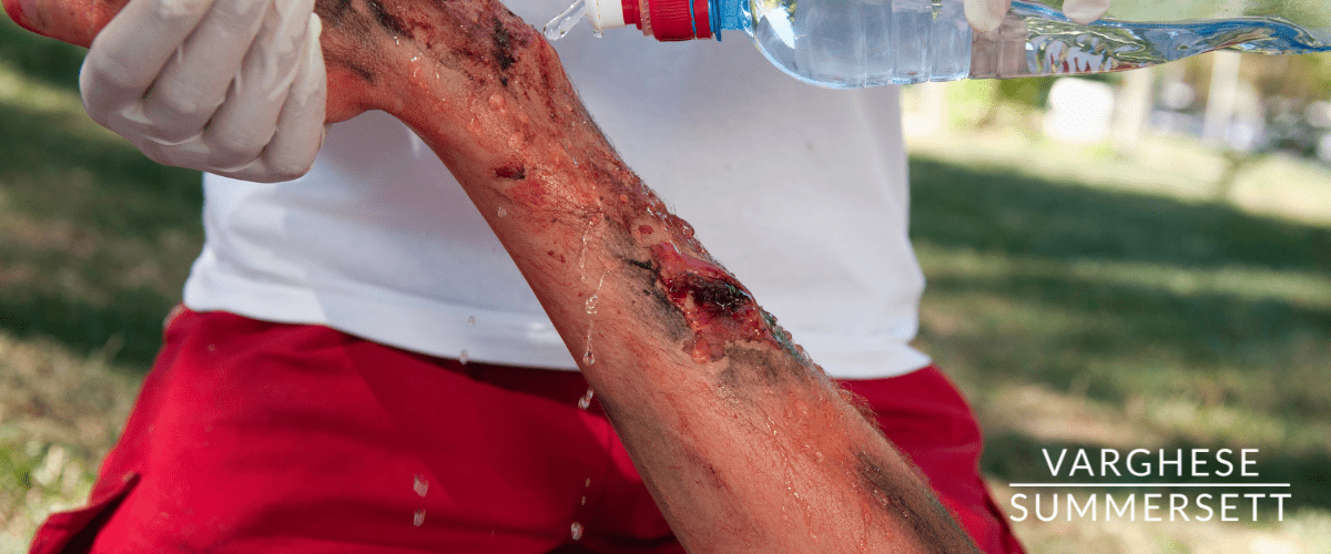 Burn Injury Lawyer