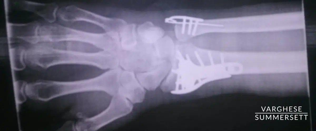 Wrist fracture from car accident